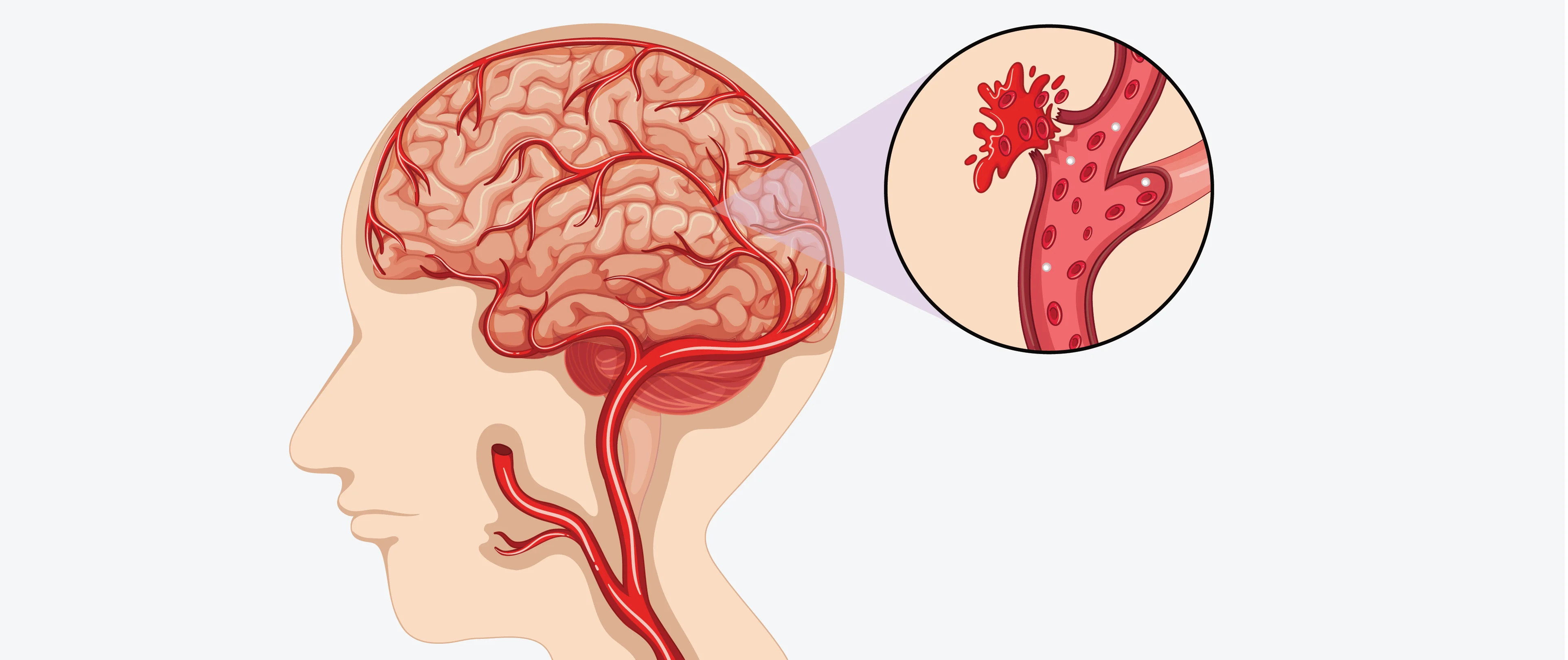 Hemorrhagic Stroke: What You Need to Know